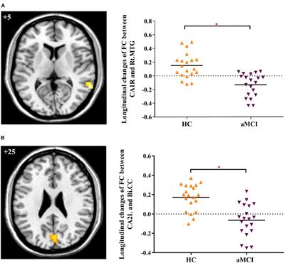 Disrupted Functional Connectivity of Cornu Ammonis Subregions in Amnestic Mild Cognitive Impairment: A Longitudinal Resting-State fMRI Study